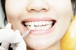 Реставрация и восстановление зубов