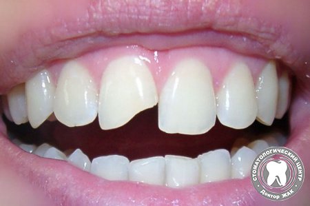 Скол переднего зуба, реставрация