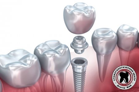 Почему необходимо проводить одномоментную имплантацию зубов