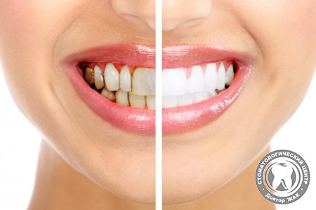 Попрощаться с зубным камнем поможет качественная профилактика