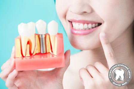 Важная информация об имплантации зубов
