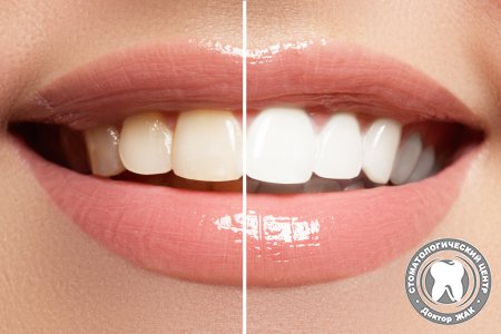 Какой метод отбеливания зубов является самым безопасным