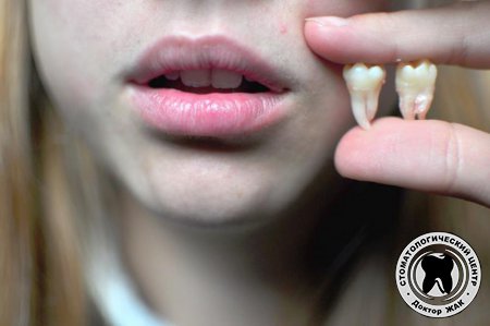 Что делать если режется зуб мудрости? | Kurtova Dental Clinic