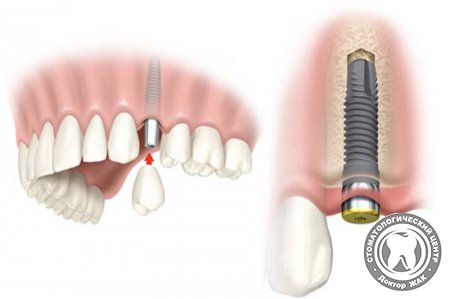 Эндоскопическая имплантация зубов