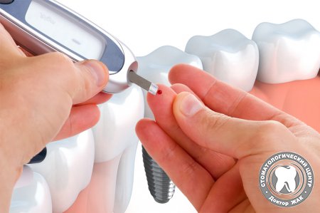 Имплантации зубов у диабетиков