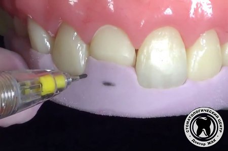Реставрация зубов с силиконовым ключом