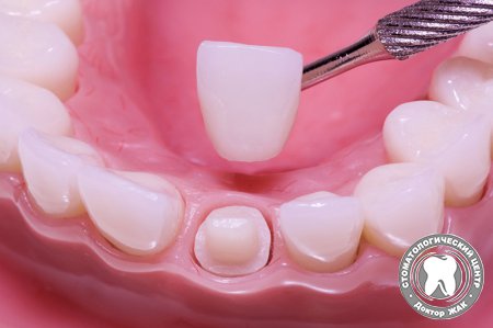 Безметалловая реставрация зубов
