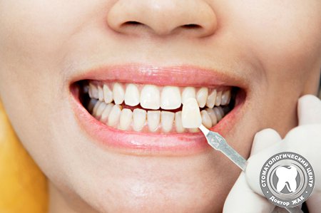 Восстановление зубов