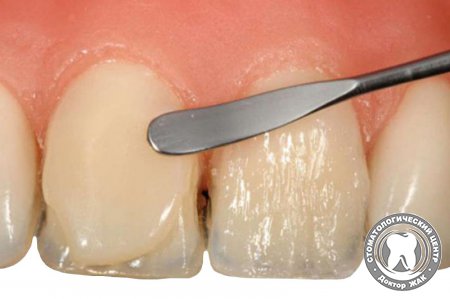 Реставрация или пломбирование зубов