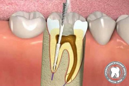 Зубные каналы