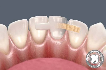 Современный метод протезирования зубов без обточки