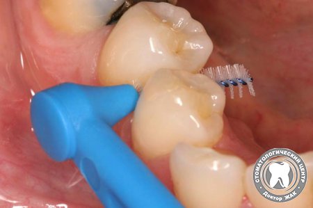 Правила ухода за зубными имплантатами
