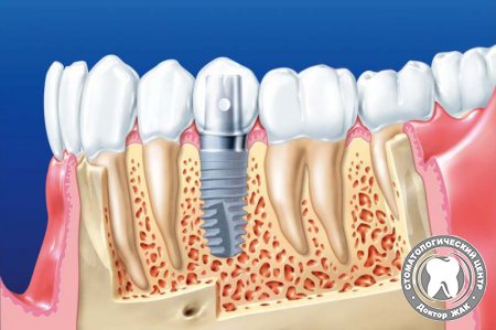 Установка имплантантов зубов