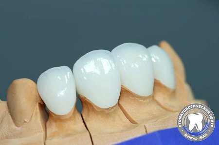 Реставрация зубов керамикой
