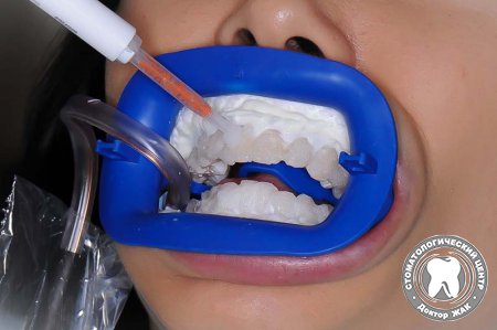 Мифы про отбеливание зубов