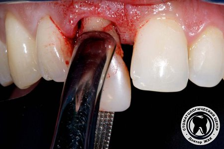 Восстановление выбитого зуба