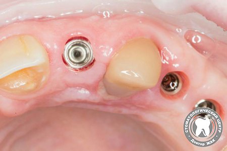 Имплантация зубов без боли