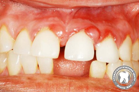 Что это такое и способы удаления гранулемы зуба