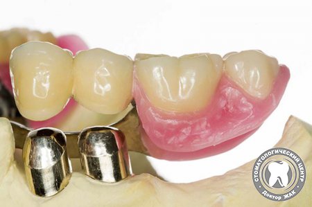 Восстановление зубного ряда с помощью бюгельных коронок