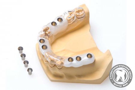 Хирургический шаблон для имплантации зубов