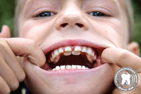 Почему у ребёнка не выпадают молочные зубы?