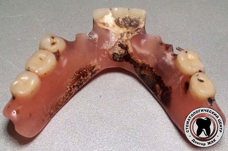 Почему съёмные зубные протезы чернеют?
