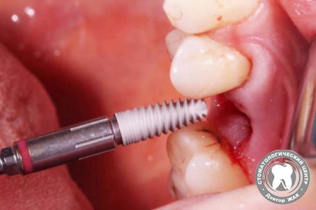 Удаление зубного импланта