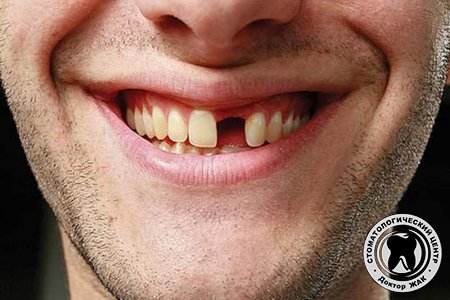 Как потеря зуба сказывается на организме