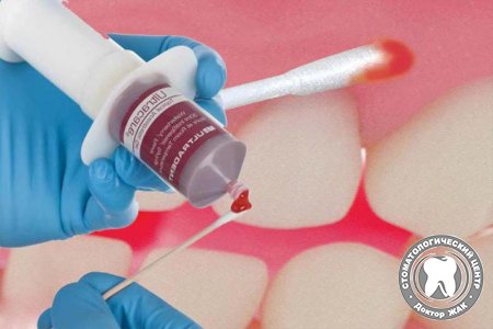 Инновационная методика анестезии при удалении и лечении зубов
