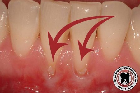 Десна отходит от зуба: причины и лечение
