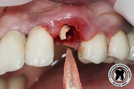 Как происходит процесс удаления гнилых зубных корней