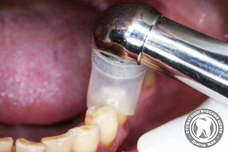 Возможно ли лечение зубов без боли?
