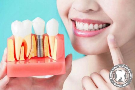 Развеем 5 основных мифов об имплантации зубов