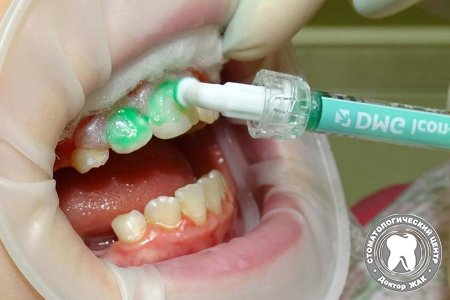 Айкон технология для лечения зубов