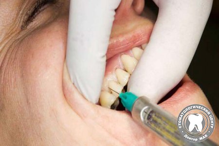 Почему не подействовала анестезия при лечении зубов?
