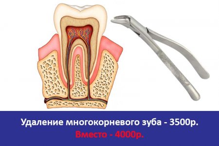 Удаление многокорневого зуба