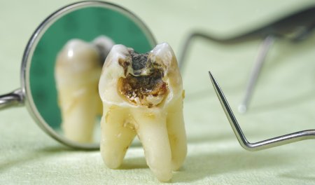 Как кариес разрушает зуб