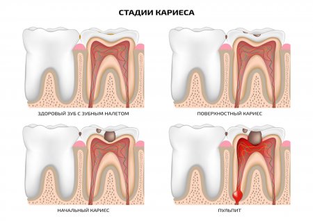 Разновидности кариеса зубов